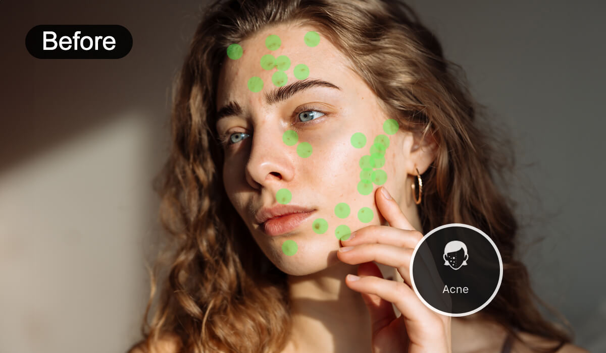 Auto Detection to Remove Acne From Photo
