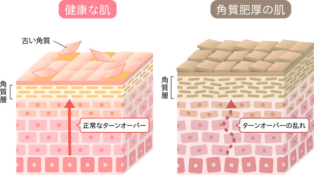 肌のターンオーバーの様子