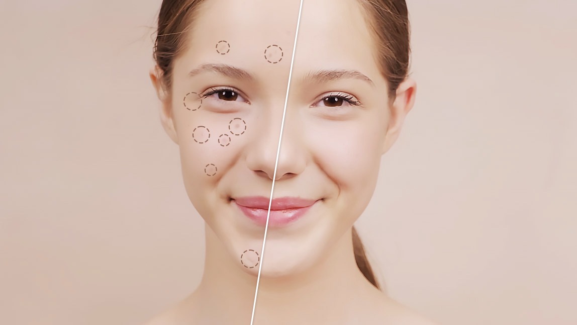 拍照臉上痘痘太明顯？美顏相機App輕鬆修痘痘、去除相片小瑕疵 PERFECT