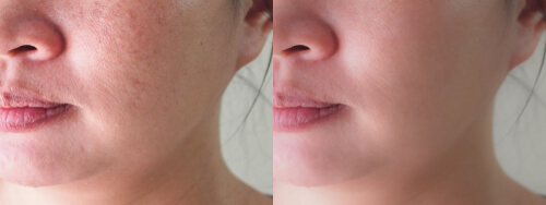 antes y despues de un producto en la dermocosmetica