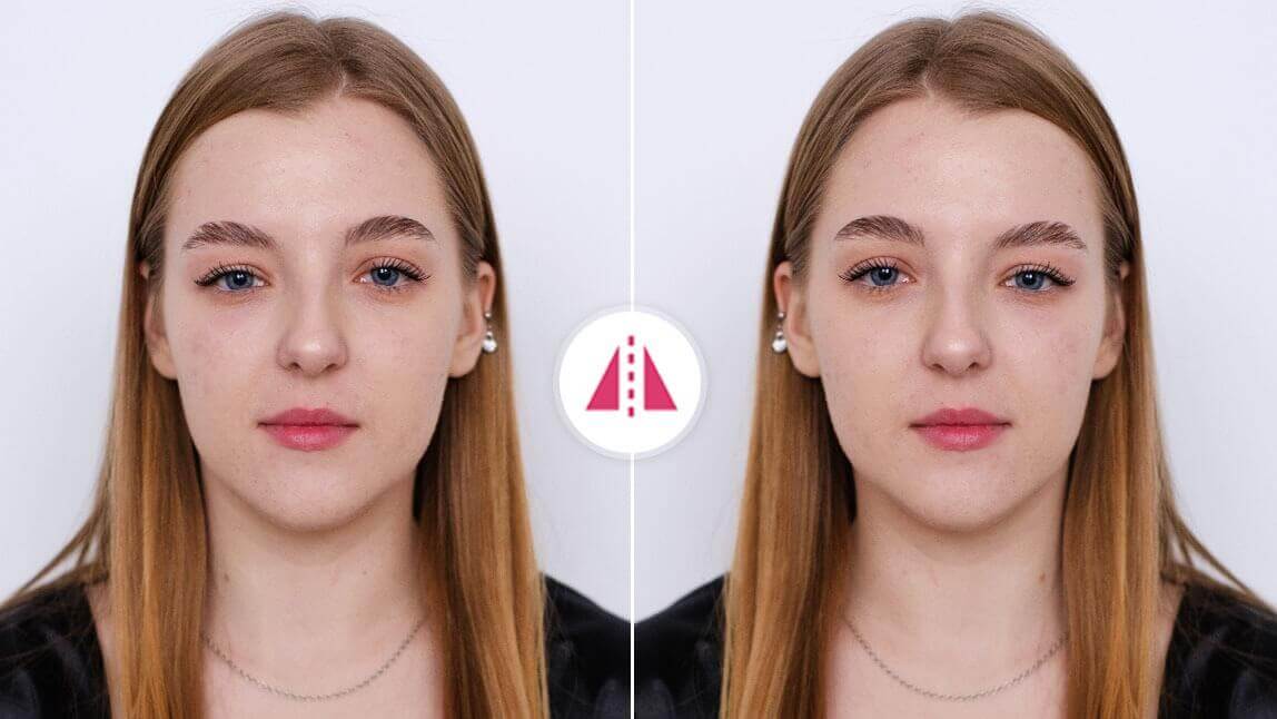 Filtro de cara asimetrica