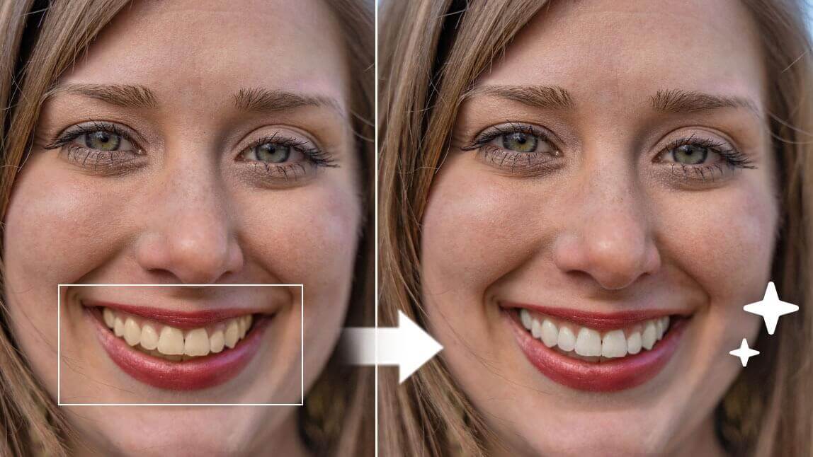 Perfect Teeth Filter: What Would I Look Like with Veneers