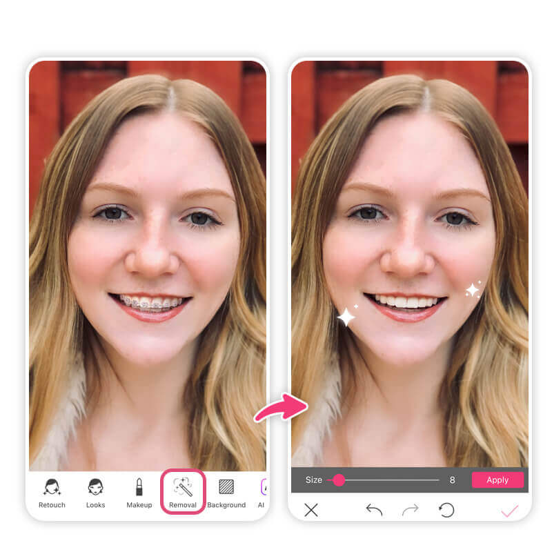 Remove braces or teeth retainer with the AI-powered removal app