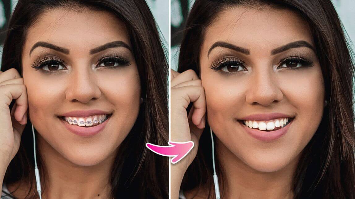 No Braces Filter: See What You Look Like Without Braces (App & Online)