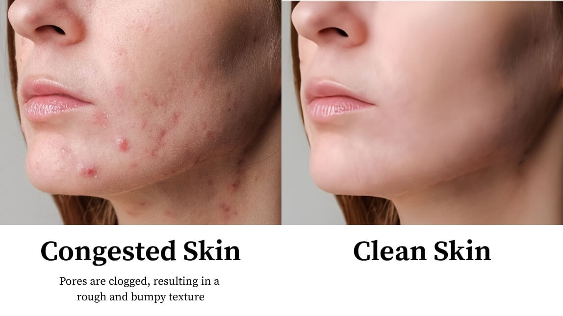 How Congested Skin and Clean Skin Look Like