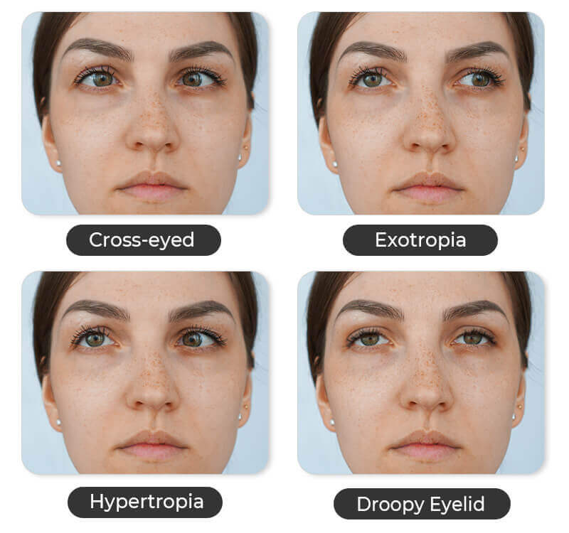 Types of Lazy Eyes in Photos