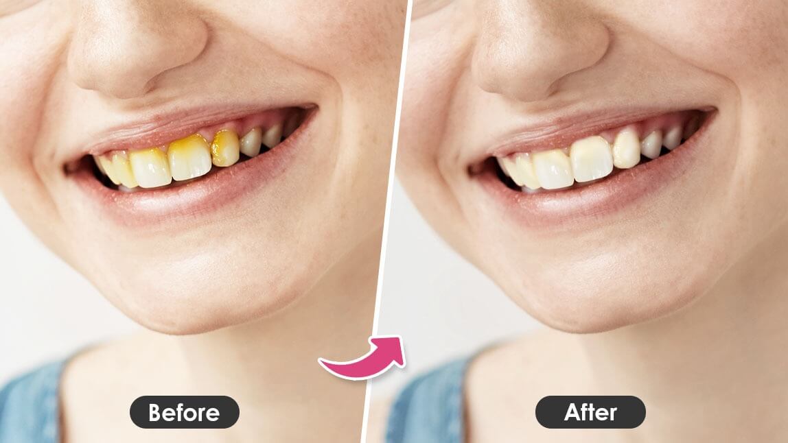 How to Get Rid of Yellow Teeth Naturally