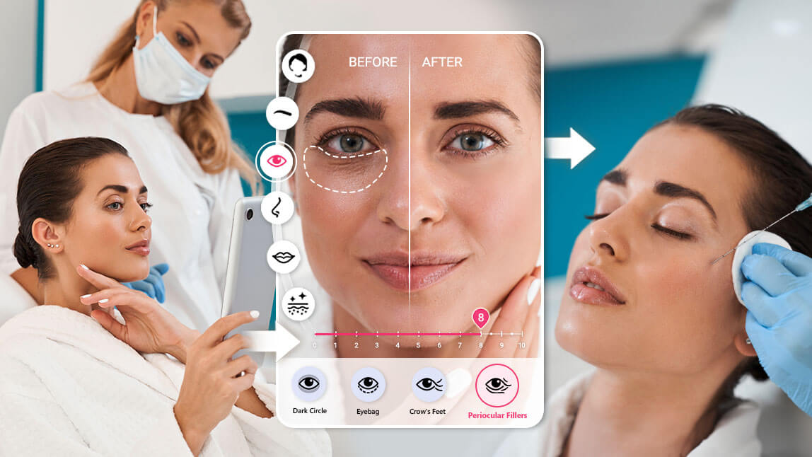 before and after for filler and botox