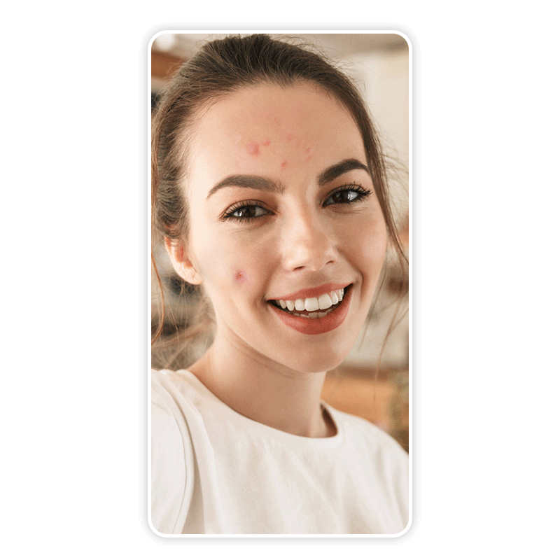 Remove pimples from photo with the best pimple remover editor.