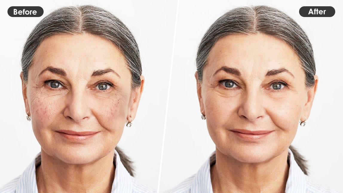 How to Remove Age Spots Naturally: 6 Best Home Remedies