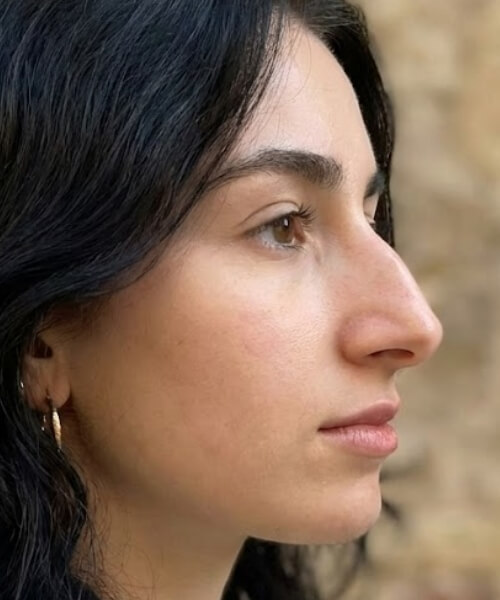 Aquiline Nose Aquiline Nose