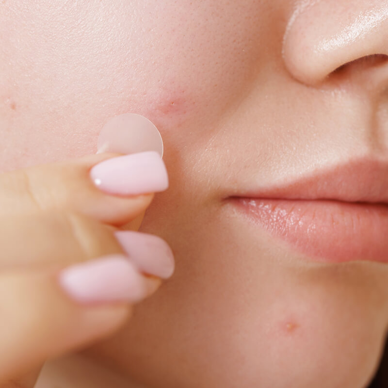 Mulher usando adesivo secativo para acne no rosto