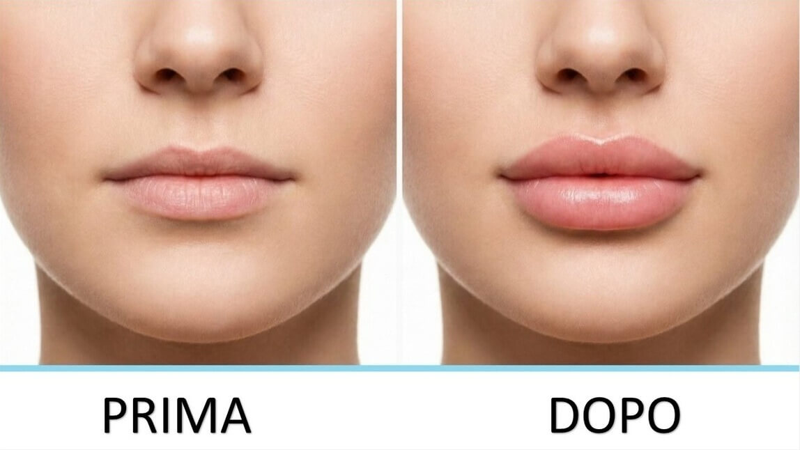 Types of Lip Fillers: Materials, Benefits & AI Lip Filler Try-On