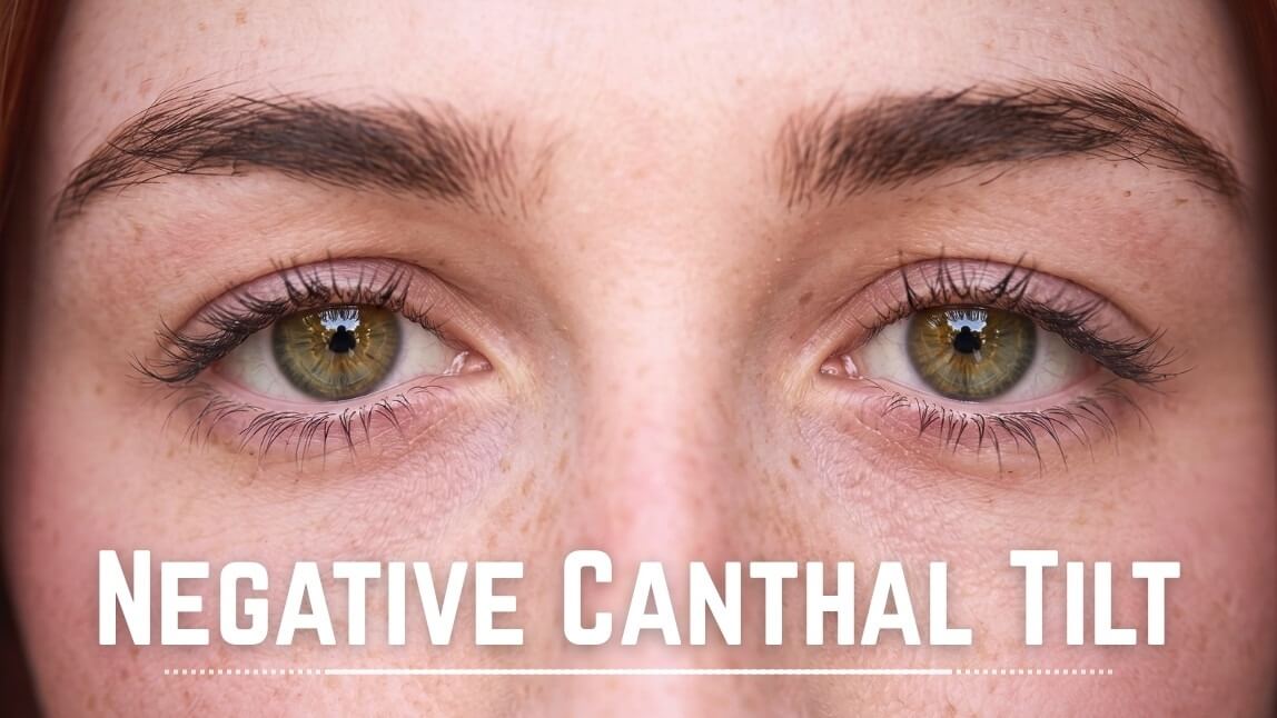 Negative Canthal Tilt: The Ultimate Guide 2026
