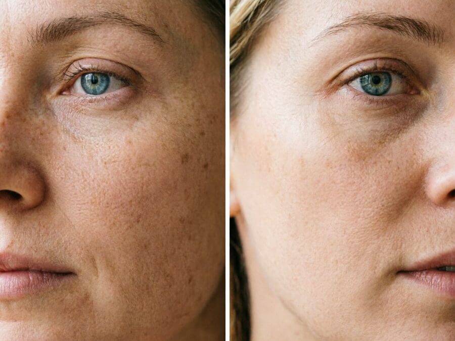 Clean skincare routine flat lay with cleanser, treatment serum, and moisturizer for acne-prone cheeks