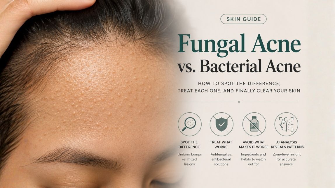Fungal Acne vs Bacterial Acne: How to Tell Which One You Have