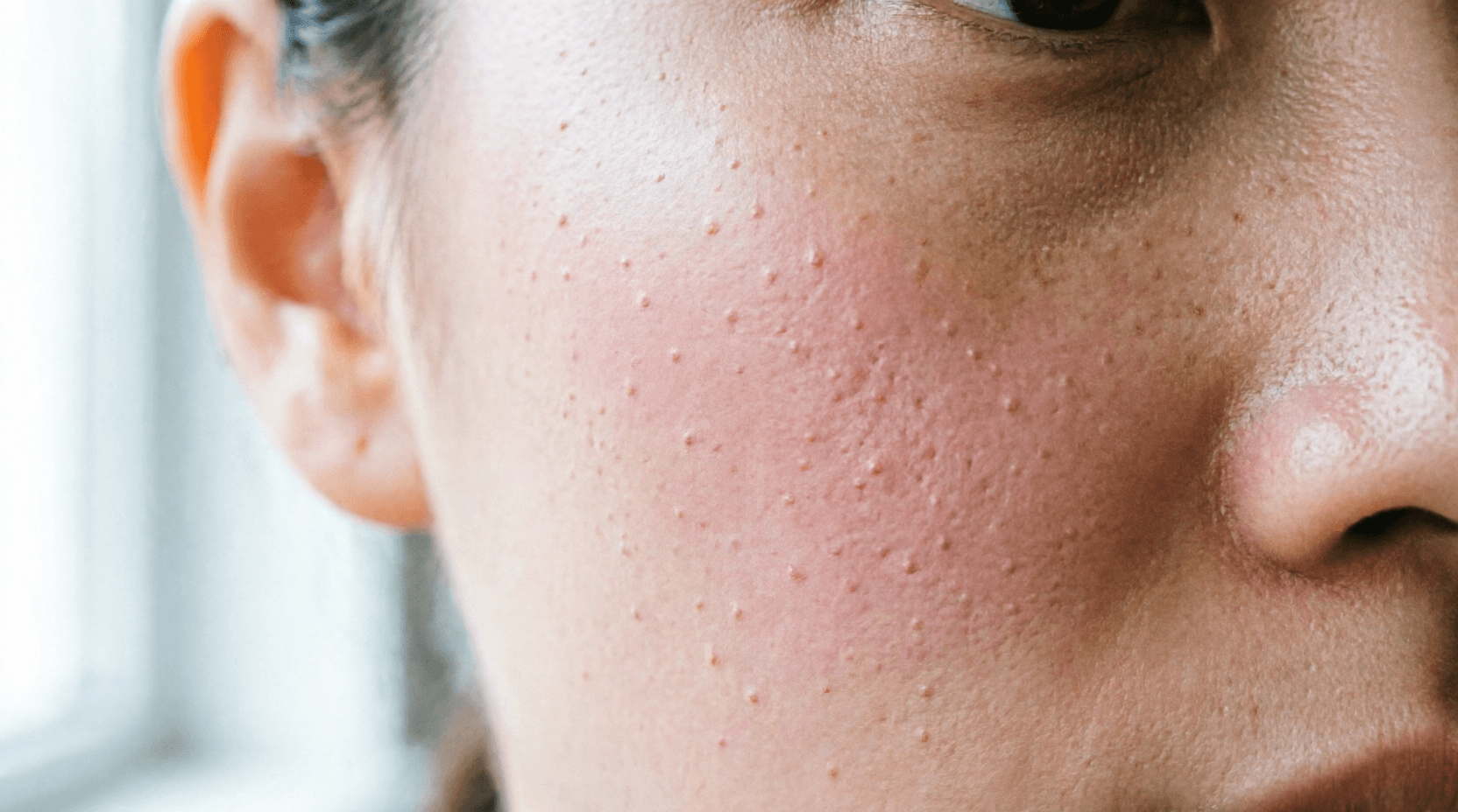 keratosis pilaris keratosis pilaris
