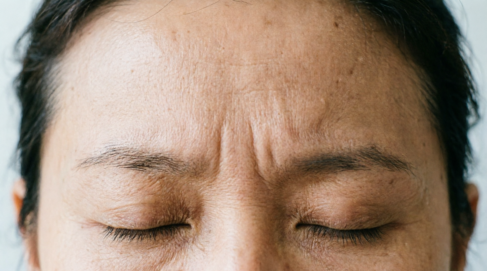 forehead wrinkles forehead wrinkles