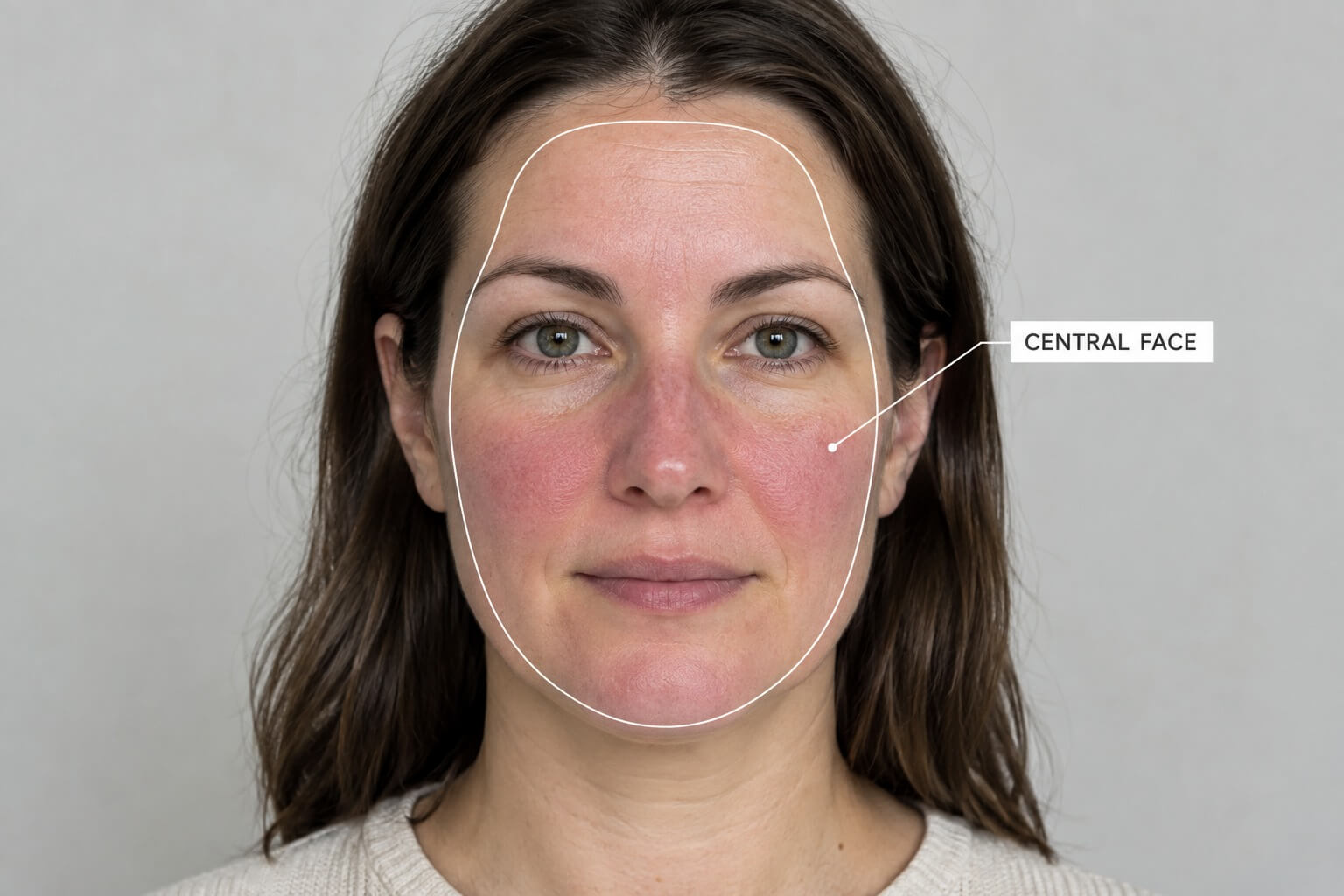 Rosacea and Acne skin analysis Rosacea and Acne skin analysis