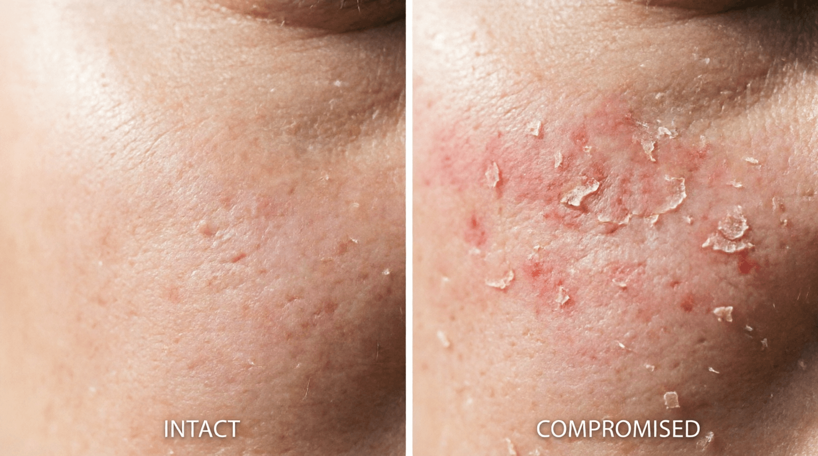 skin barrier