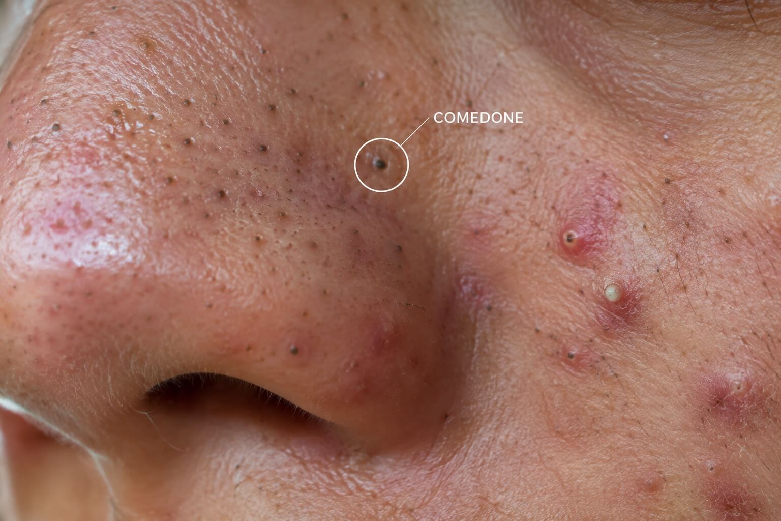 Rosacea and Acne skin analysis Rosacea and Acne skin analysis