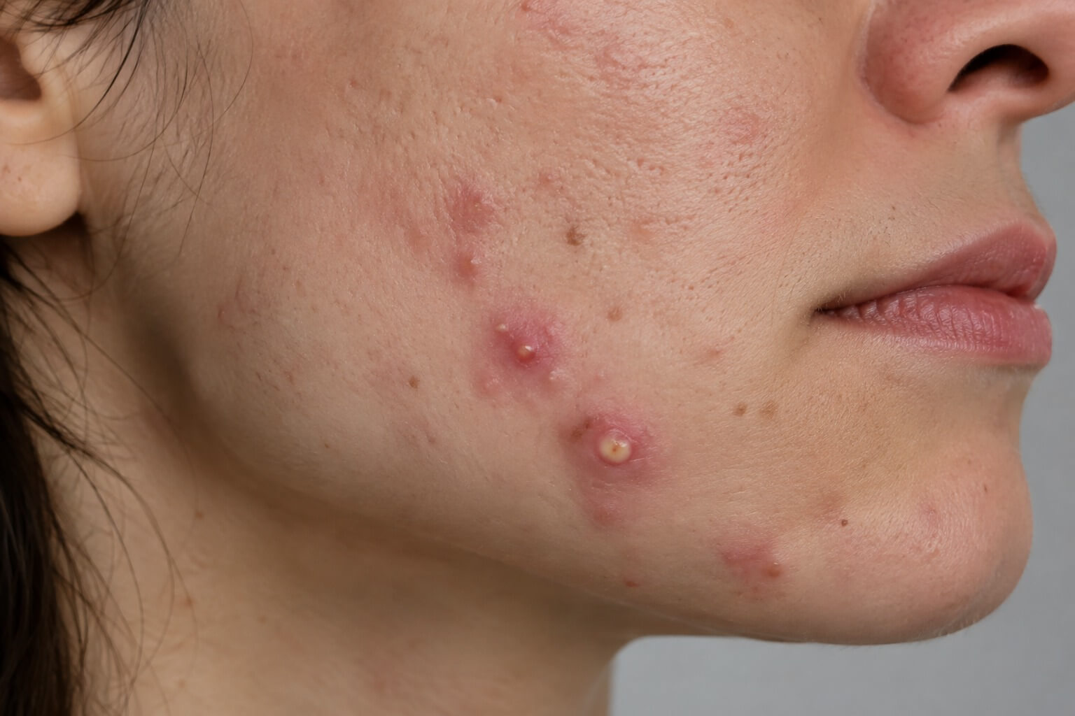 acne analysis acne analysis