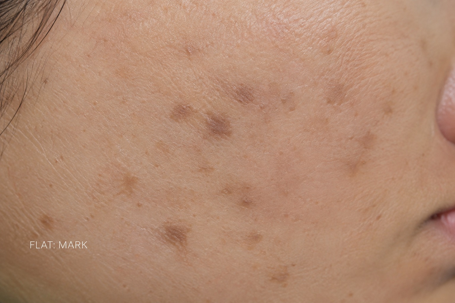 acne marks