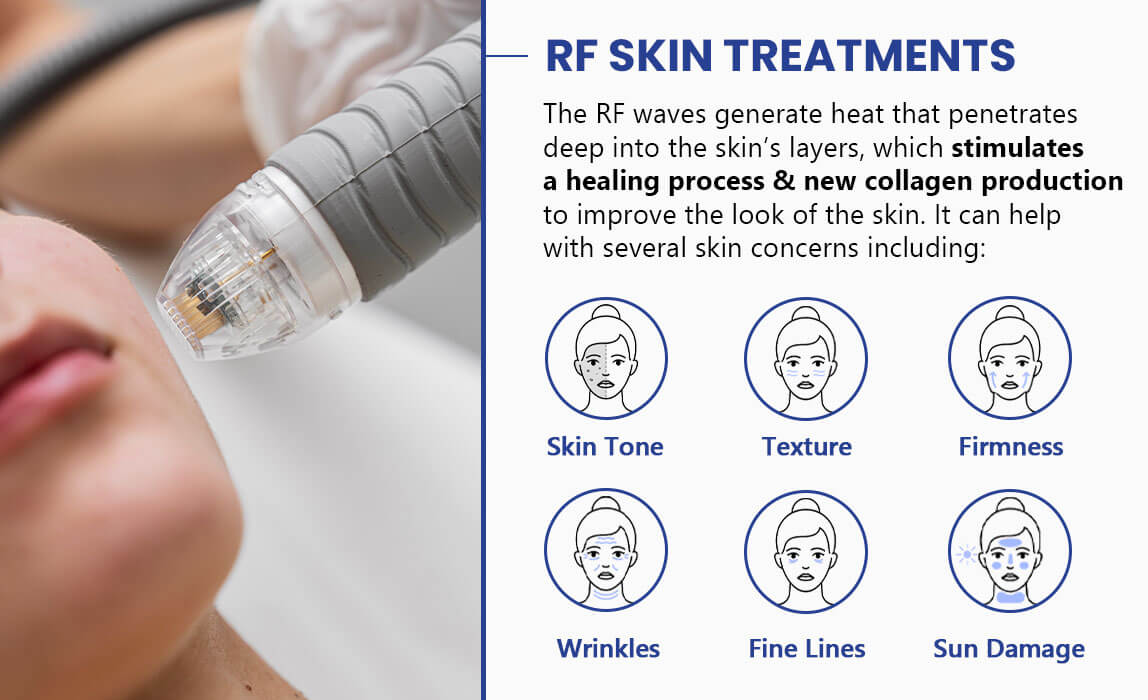 Radio Frequency (RF) skin treatments