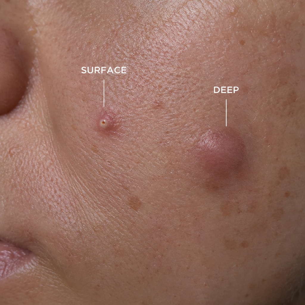 blind pimple blind pimple