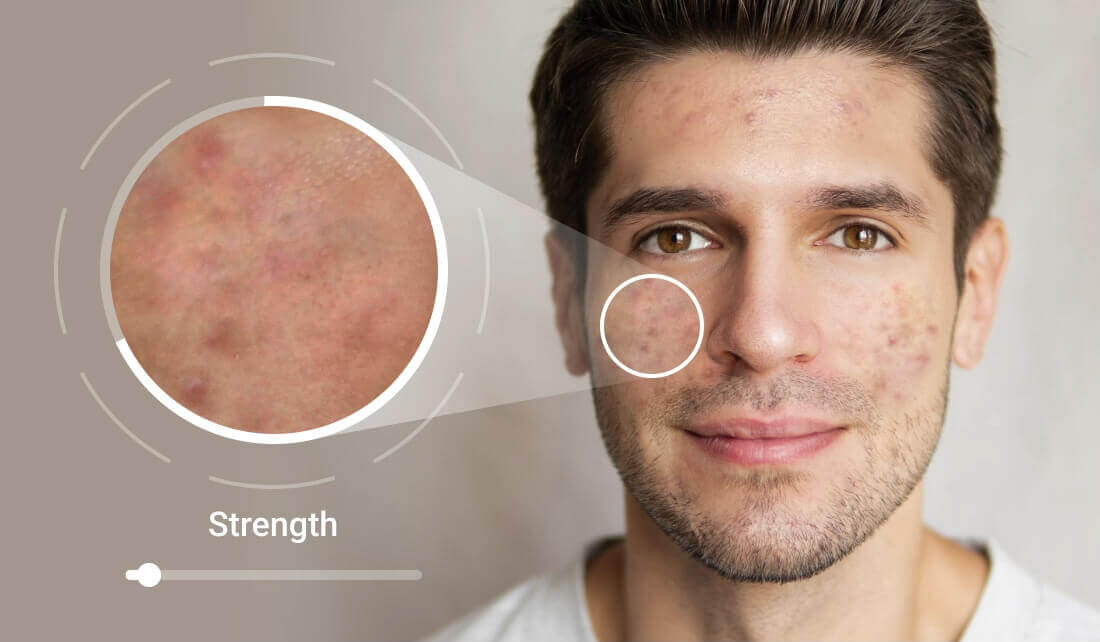 Resultados de análisis de piel online para hombres con inteligencia artificial.