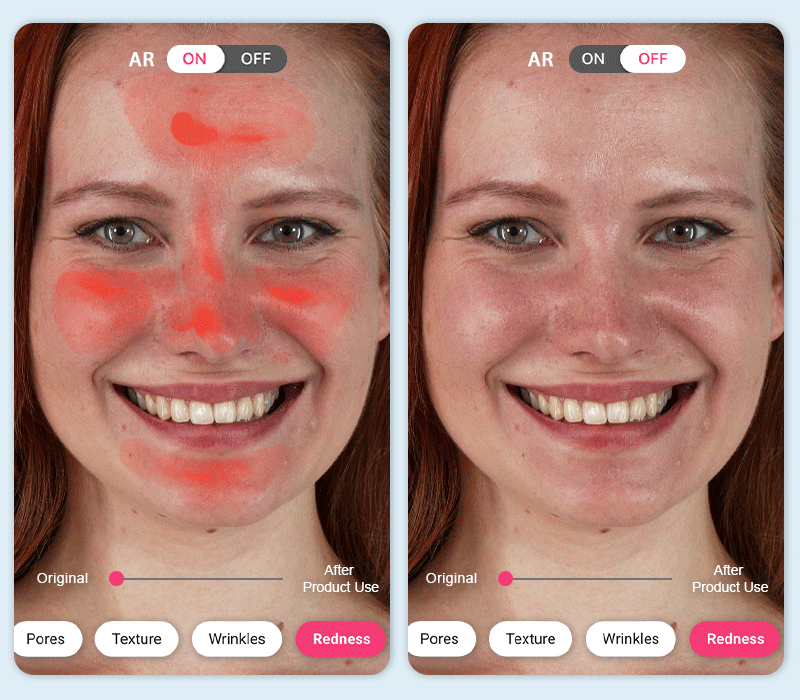 Redness