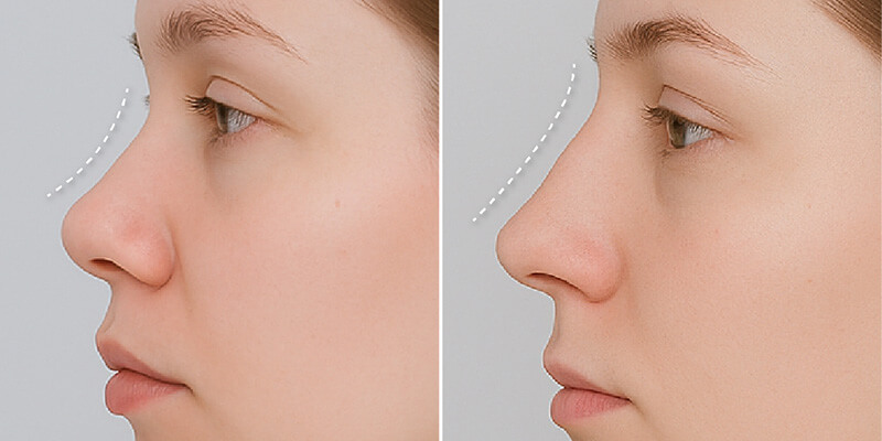 Overview of Nose Job