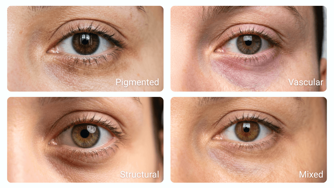 AI Dark Circle Analyzer classifying pigmented vascular and structural under-eye types
