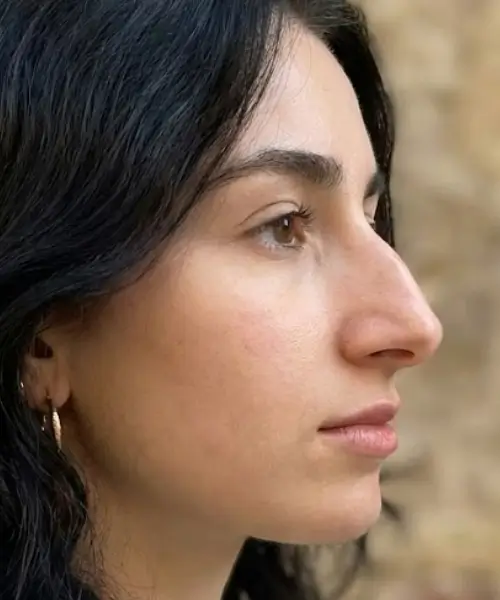 Aquiline Nose