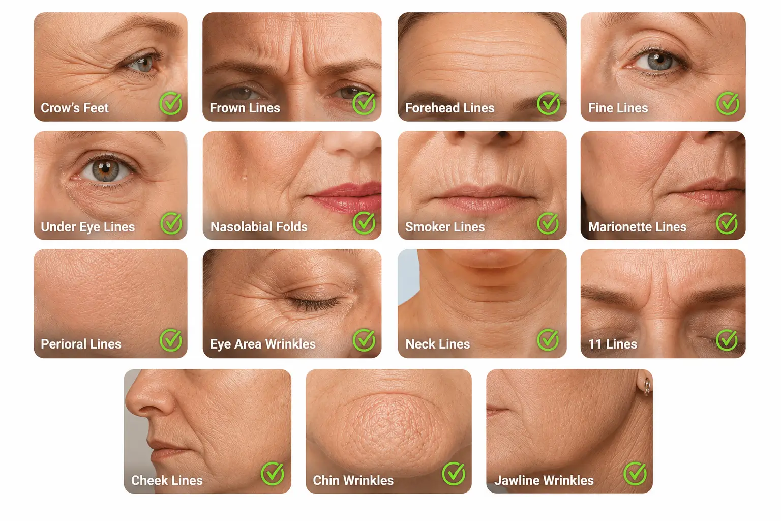 Wrinkle detection mapped across forehead crow's feet and nasolabial fold zones